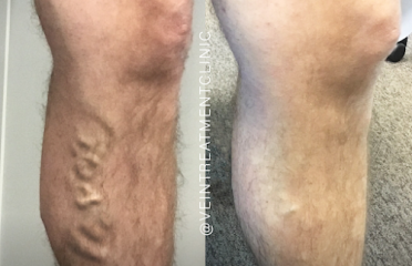 Vein Treatment Clinic | Farmington