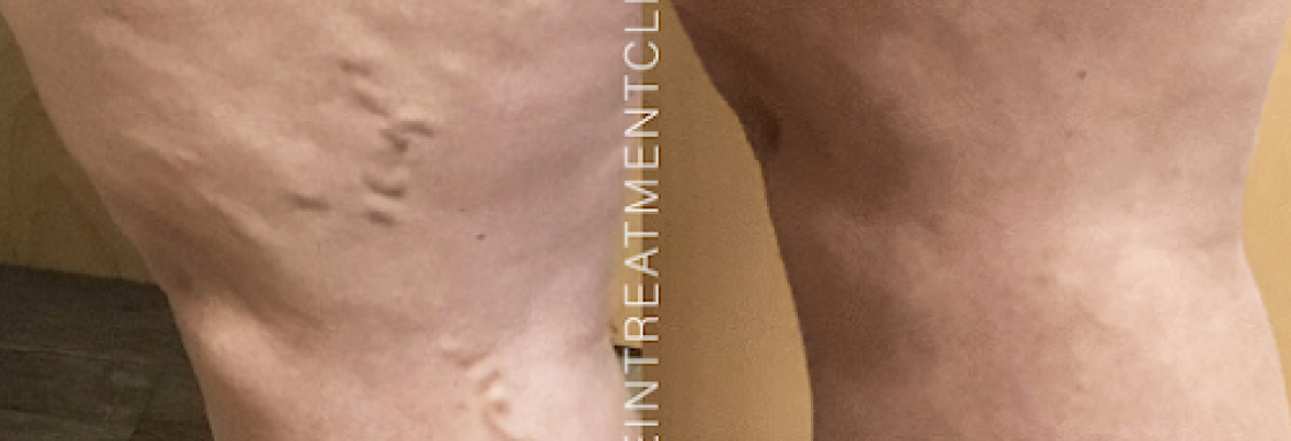 Vein Treatment Clinic | Hamden, CT