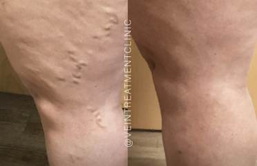 Vein Treatment Clinic | Hamden, CT